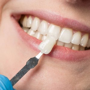 Veneer wird an Zahnreihe gehalten