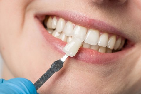 Veneer wird an Zahnreihe gehalten