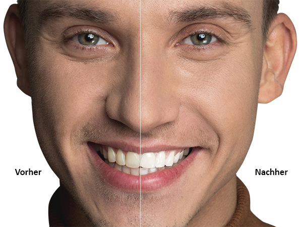 Bleaching Mann Vorher-Nachher AllDent 