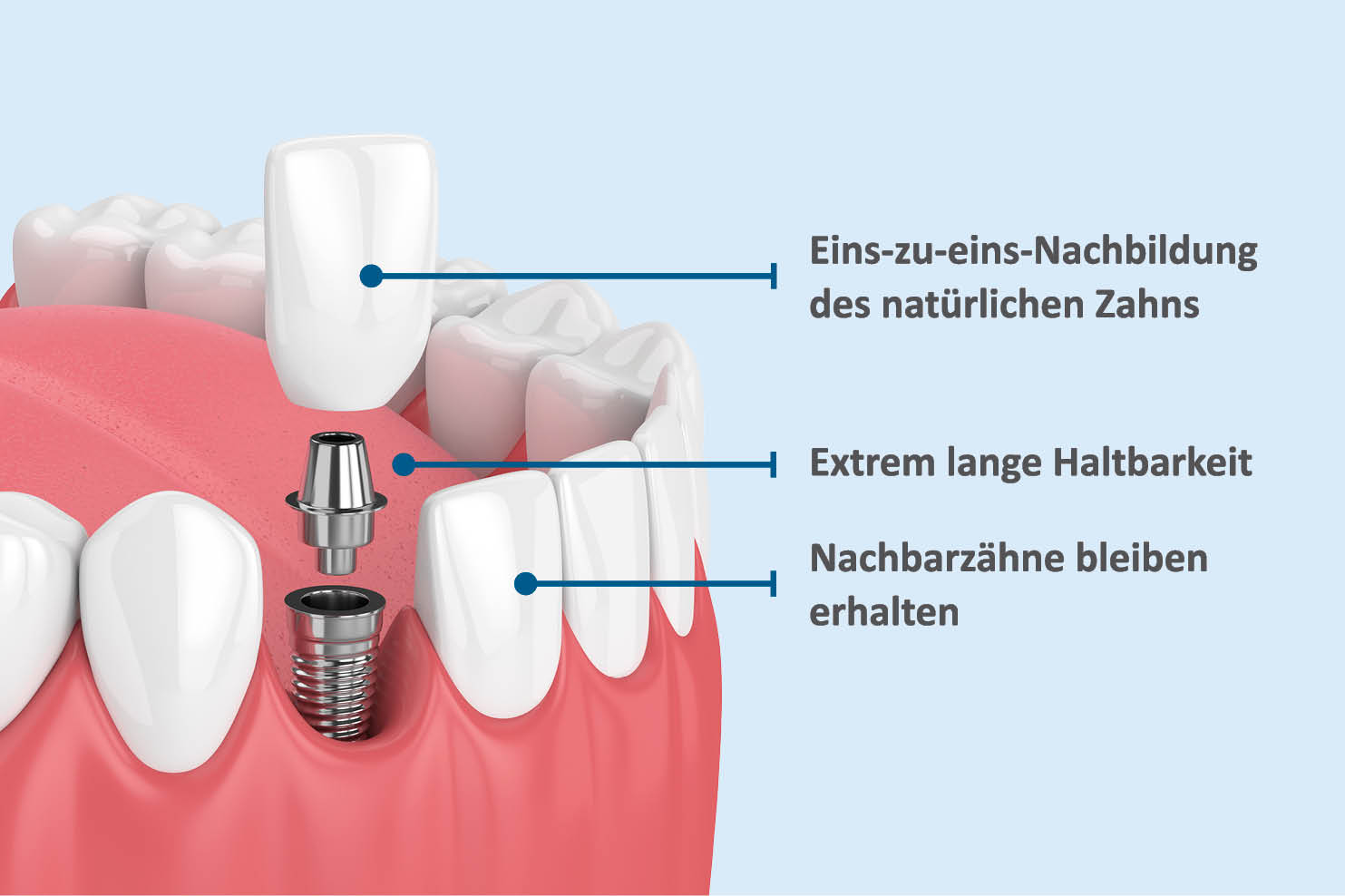 Zahnimplantat Darstellung AllDent